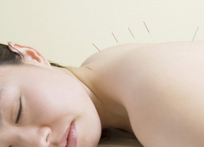 acupunctur